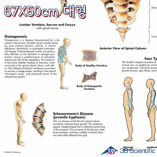 3B 척추차트 VR1152 Spinal Column 척추질병 병원액자_액자추가