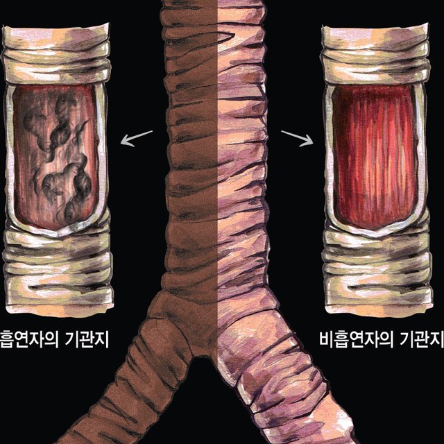 태양의료기 폐비교모형 금연교육 흡연예방 흡연자의폐 교구세트